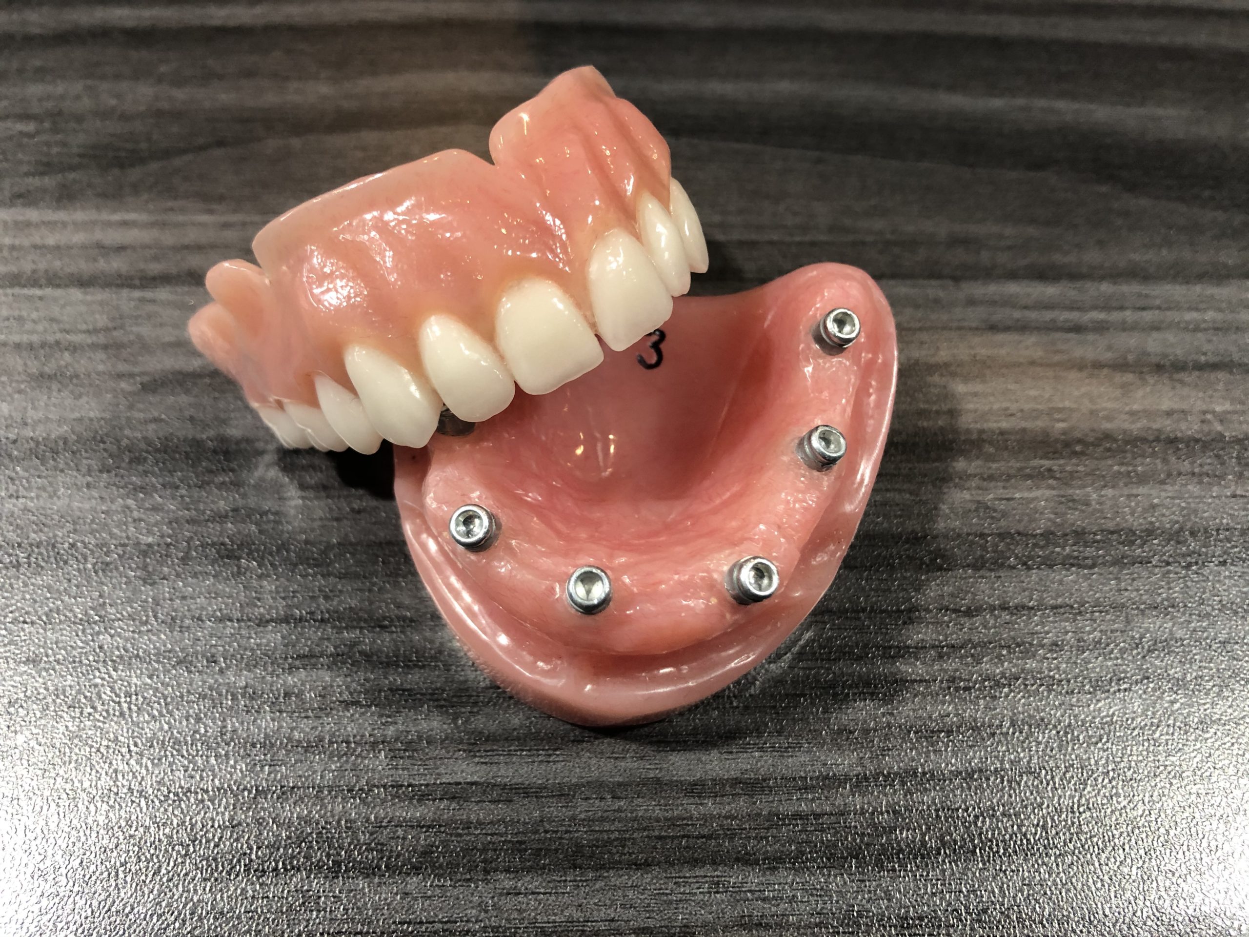 Prothèse dentaire sur implant Saint-Jérôme, Laurentides | Services